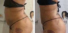 HD Laser LIPO 360 Services