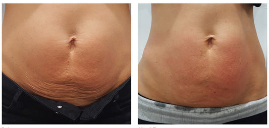 Loose Skin Repair (non-surgical) Services