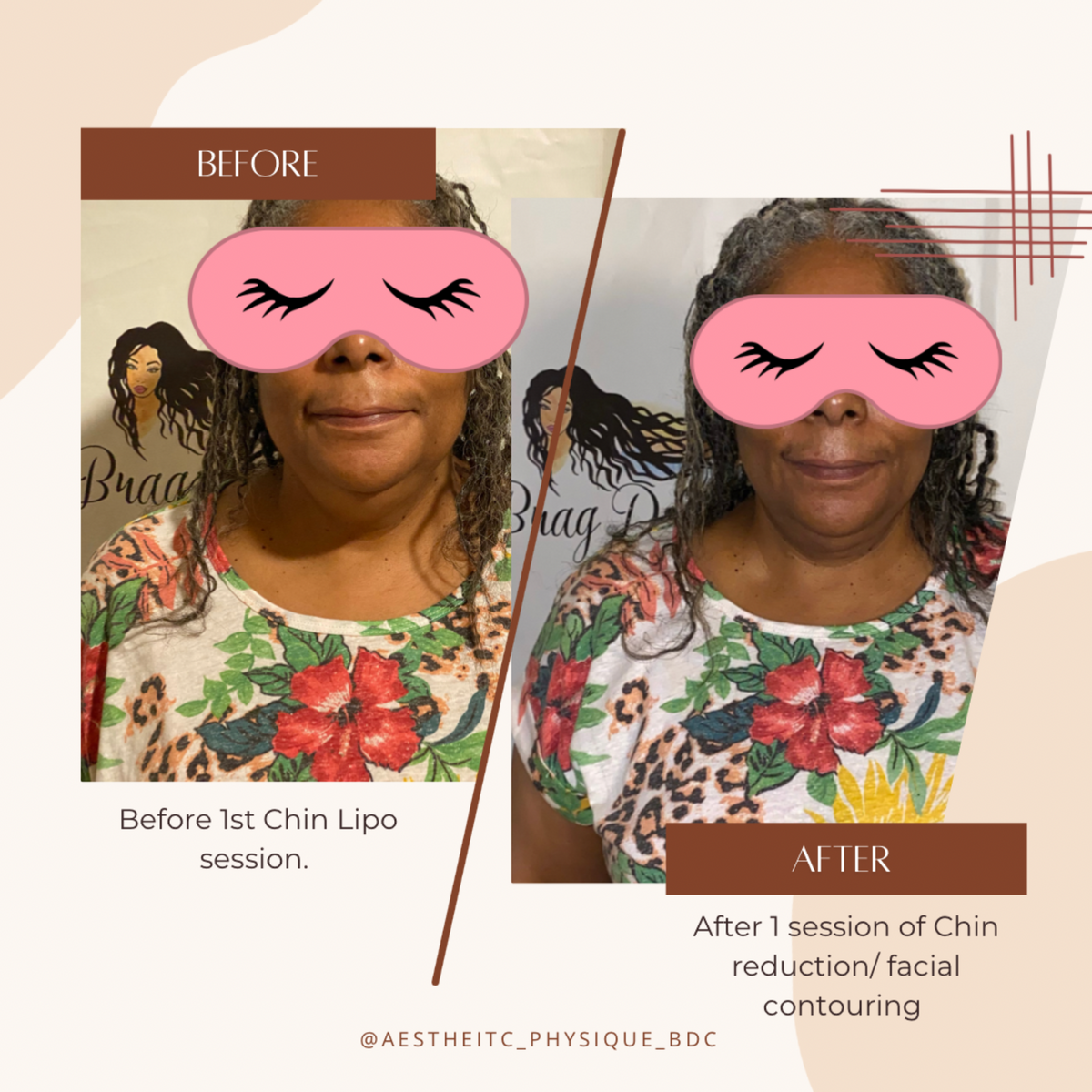 Double Chin Removal/ Facial Contouring Services