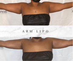 Arm Sculpt (Non-Invasive) Services